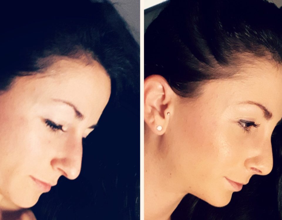 Fitness Model Janine Lewis Nasenkorrektur (Rhinoplastik)